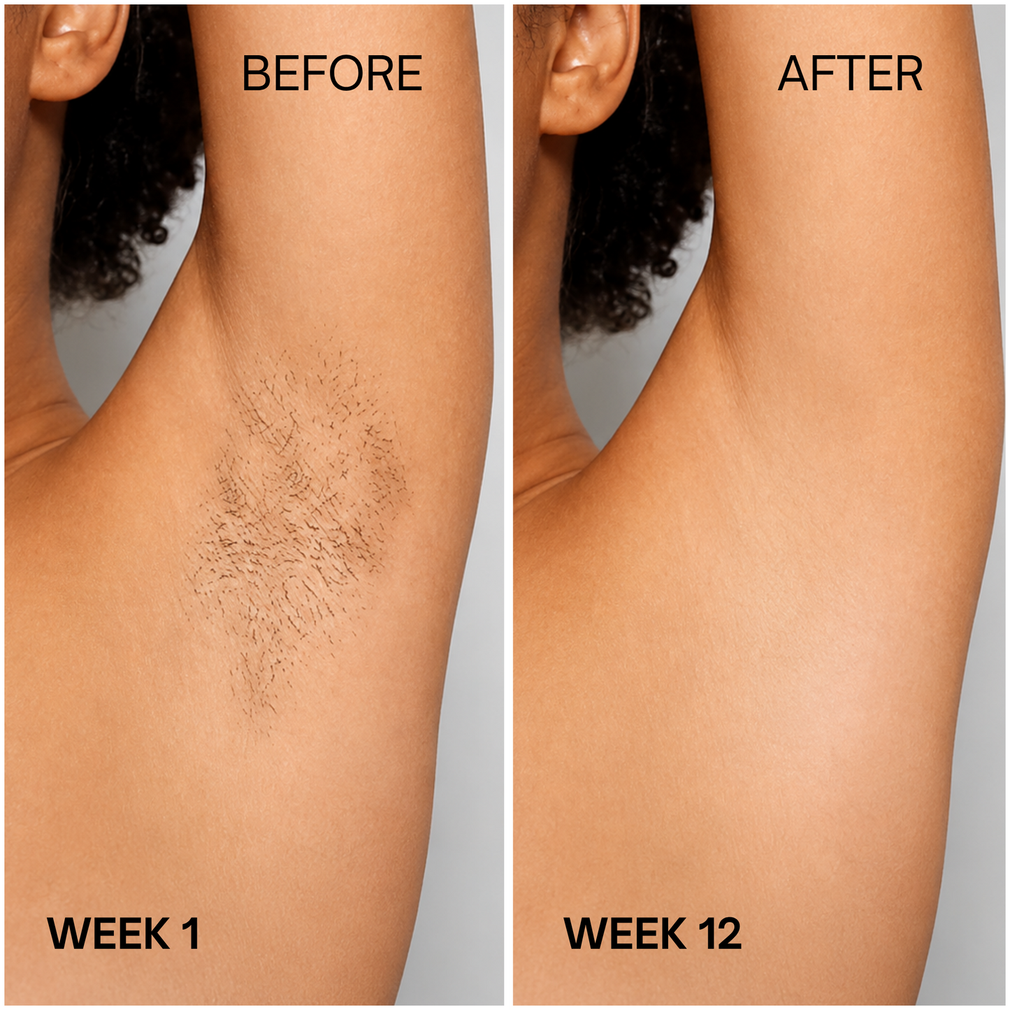 IPL Laser Hair Removal Device