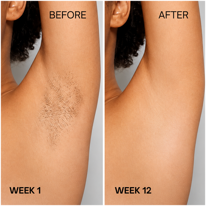 IPL Laser Hair Removal Device